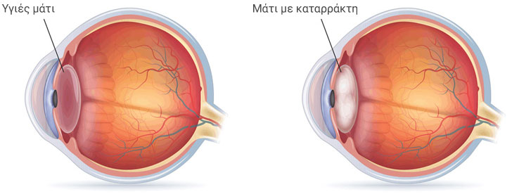 Τι ειναι ο καταρρακτης…αιτια…συμπτώματα…θεραπεία